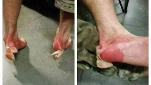 踢足球脚蜕皮正常吗？探究背后原因与应对之法