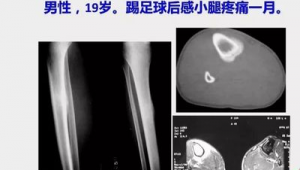 胫腓骨骨折后能否踢足球?康复之路与重返绿茵的思索