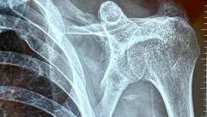 锁骨骨折后还能踢足球吗？康复与运动风险全解析