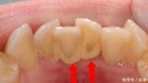 牙齿不齐对女生练足球有影响吗