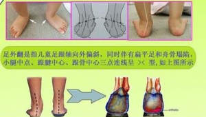 足跟外翻的女生能否踢足球?这份指南请查收