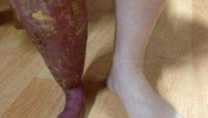 腿烧伤后还能重返绿茵场踢球吗？这背后的真相来了