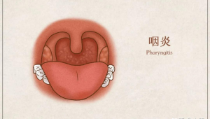 患有慢性咽炎能踢足球吗?这些要点你得知道