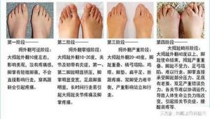 拇外翻患者能否踢足球？了解这些再做决定