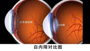 白内障术后能踢足球吗