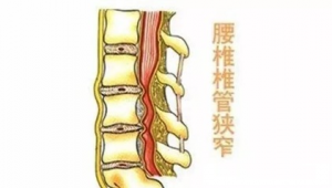 腰椎管狭窄患者能否踢足球?这些要点需知晓