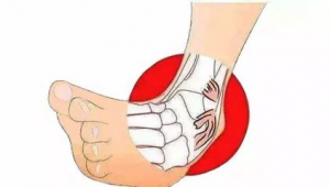 足球踝是急性损伤吗