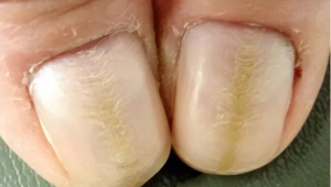 足球指甲流脓能自愈吗？探究其状况与恢复可能性