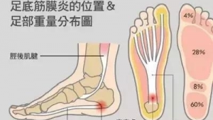 足膜炎情况下能否踢足球,这些要点你得知道