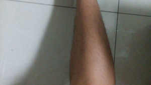 踢足球会导致小腿外翻吗