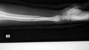 胳膊骨折能否踢足球？答案关乎健康与安全需谨慎考量