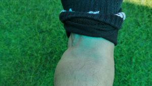 踢足球脚踝痛正常吗?是受伤信号还是运动常态?