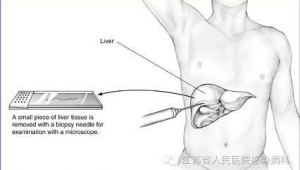 肝穿刺后踢足球有无影响,你想知道的答案都在这里!