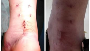 踢足球会导致跟腱断裂吗