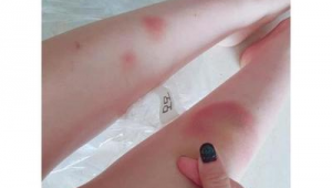 被足球砸青了能恢复吗？了解恢复方法与时间，让淤青快速消散