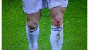 足球钉鞋容易受伤吗？深度剖析钉鞋与运动损伤的关联