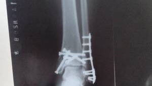 脚踝放了钢板还能踢足球吗？这些因素需考量