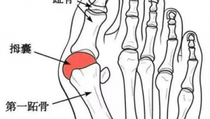 女生脚骨外翻影响踢足球吗？答案可能出乎你意料！